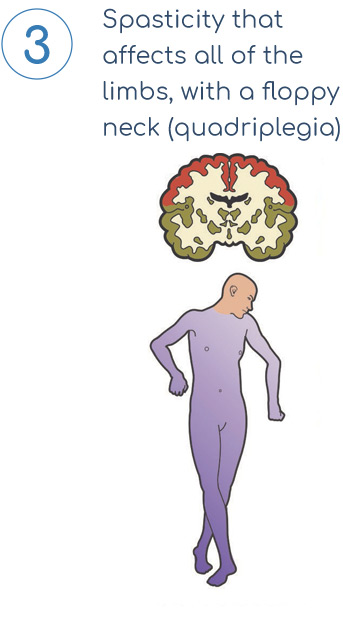 spastic cerebral palsy