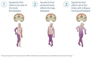 Saol-Lioresal_3-Kinds-of-spastic-cerebral-palsy - Lioresal® Intrathecal