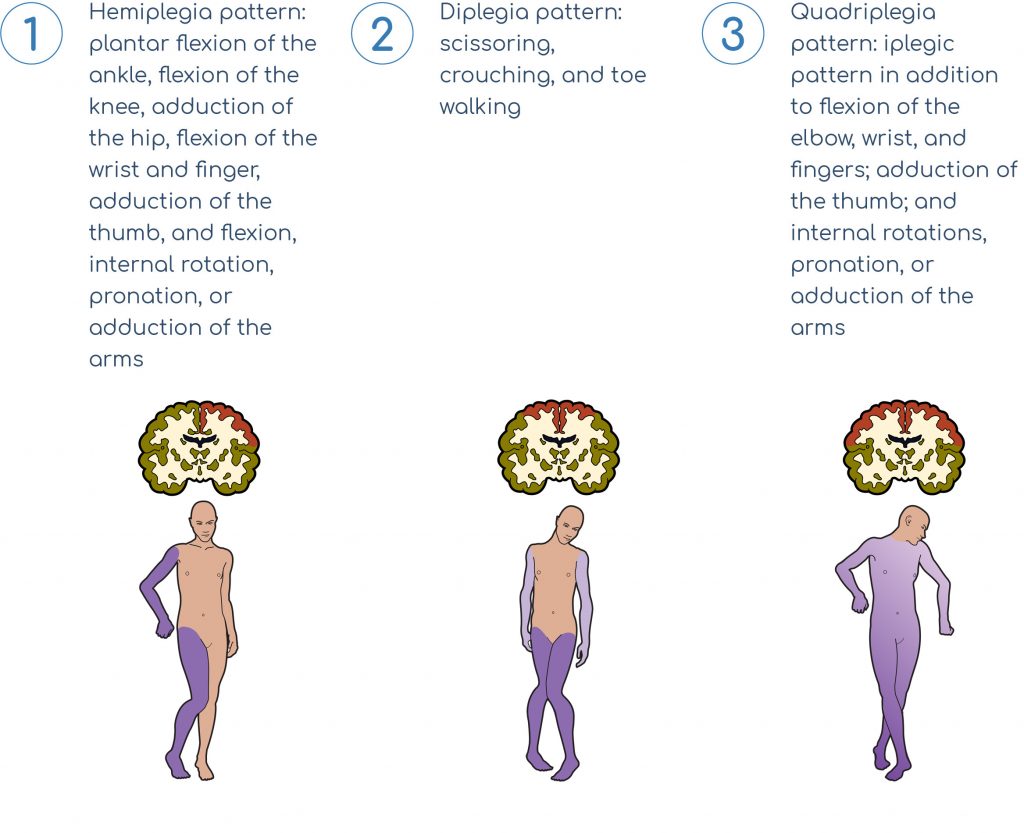 3 1 2 graphic Lioresal Intrathecal spastic-diplegia